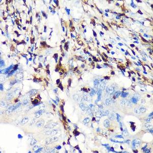 Immunohistochemistry analysis of paraffin-embedded human colon carcinoma tissue using Anti-S100A4 Antibody [ARC0475] (A305282) at a dilution of 1:100 (40X lens). Perform microwave antigen retrieval with 10 mM PBS buffer pH 7.2 before commencing with IHC staining protocol