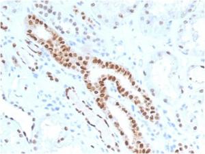 Immunohistochemical analysis of formalin-fixed, paraffin-embedded human renal cell carcinoma using Anti-PAX8 Antibody [PAX8/1491]