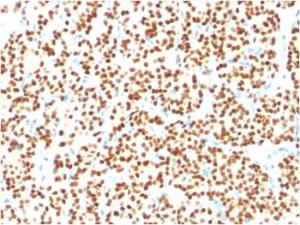 Immunohistochemical analysis of formalin-fixed, paraffin-embedded human thyroid carcinoma using Anti-PAX8 Antibody [PAX8/1491]