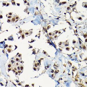 Immunohistochemistry analysis of paraffin-embedded human breast cancer tissue using Anti-Smad2 Antibody (A93131) at a dilution of 1:100 (40X lens). Perform high pressure antigen retrieval with 10 mM citrate buffer pH 6.0 before commencing with IHC staining protocol