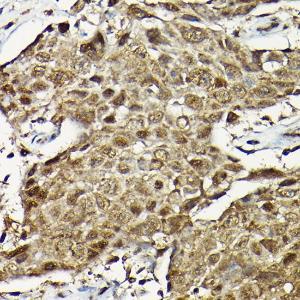 Immunohistochemistry analysis of paraffin-embedded human urothelial carcinoma using Anti-Smad2 Antibody (A93131) at a dilution of 1:100 (40X lens). Perform high pressure antigen retrieval with 10 mM citrate buffer pH 6.0 before commencing with IHC staining protocol