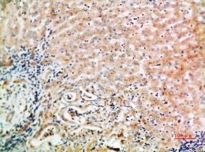 Immunohistochemical analysis of paraffin-embedded human liver cancer using Anti-WISP3 Antibody