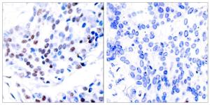 Immunohistochemical analysis of paraffin-embedded human breast carcinoma tissue using Anti-c-Jun Antibody. The right hand panel represents a negative control, where the Antibody was pre-incubated with the immunising peptide