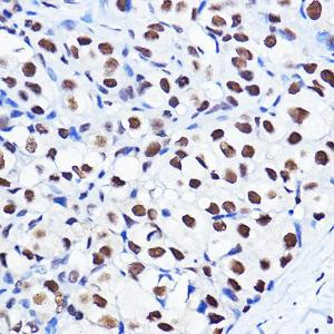 Immunohistochemistry analysis of paraffin-embedded human breast cancer tissue using Anti-Cyclin D1 (phospho Thr286) Antibody (A305286) at a dilution of 1:100 (40X lens). Perform high pressure antigen retrieval with 10 mM citrate buffer pH 6.0 before commencing with IHC staining protocol