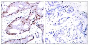 Immunohistochemical analysis of paraffin-embedded human breast carcinoma tissue using Anti-c-Jun Antibody. The right hand panel represents a negative control, where the antibody was pre-incubated with the immunising peptide