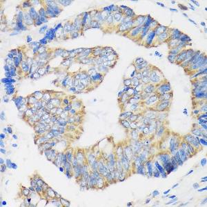 Immunohistochemistry analysis of paraffin-embedded human colon carcinoma tissue using Anti-RPL35 Antibody (A309114) at a dilution of 1:100 (40X lens). Perform microwave antigen retrieval with 10 mM PBS buffer pH 7.2 before commencing with IHC staining protocol