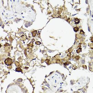 Immunohistochemistry analysis of paraffin-embedded human lung cancer using Anti-IL-6R Antibody (A8941) at a dilution of 1:50 (40x lens). Perform high pressure antigen retrieval with 10 mM citrate buffer pH 6.0 before commencing with IHC staining protocol