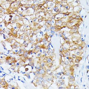 Immunohistochemistry analysis of paraffin-embedded human mammary cancer using Anti-ECE1 Antibody (A305292) at a dilution of 1:100 (40x lens). Perform microwave antigen retrieval with 10 mM PBS buffer pH 7.2 before commencing with IHC staining protocol.