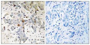 Immunohistochemical analysis of paraffin-embedded human breast carcinoma tissue using Anti-ZCCHC17 Antibody. The right hand panel represents a negative control, where the Antibody was pre-incubated with the immunising peptide