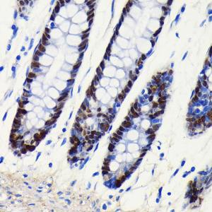 Immunohistochemistry analysis of paraffin-embedded human colon tissue using Anti-SOX9 Antibody [ARC0190] (A306215) at a dilution of 1:100 (40x lens). Perform microwave antigen retrieval with 10 mM PBS buffer pH 7.2 before commencing with IHC staining protocol