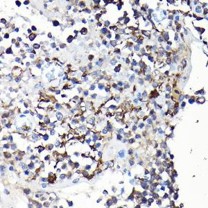 Immunohistochemistry analysis of paraffin-embedded human extranodal NK-T cell lymphoma using Anti-YAP1 Antibody (A93149) at a dilution of 1:100 (40X lens). Perform high pressure antigen retrieval with 10 mM citrate buffer pH 6.0 before commencing with IHC staining protocol