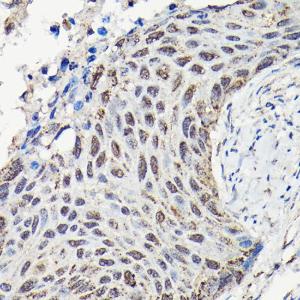 Immunohistochemistry analysis of paraffin-embedded human lung squamous carcinoma tissue using Anti-YAP1 Antibody (A93149) at a dilution of 1:100 (40X lens). Perform high pressure antigen retrieval with 10 mM citrate buffer pH 6.0 before commencing with IHC staining protocol