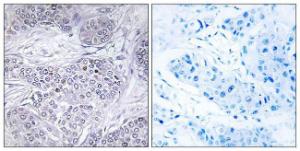 Immunohistochemical analysis of paraffin-embedded human breast carcinoma tissue using Anti-CEBPG Antibody. The right hand panel represents a negative control, where the antibody was pre-incubated with the immunising peptide.