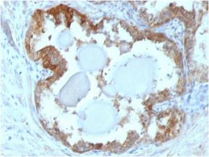 Immunohistochemical analysis of formalin-fixed, paraffin-embedded human prostate carcinoma using Anti-HSP27 Antibody [G3.1]