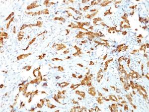 Immunohistochemical analysis of formalin-fixed, paraffin-embedded human breast carcinoma using Anti-HSP27 Antibody [G3.1]