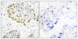 Immunohistochemical analysis of paraffin-embedded human lung carcinoma tissue using Anti-STAT5A Antibody The right hand panel represents a negative control, where the antibody was pre-incubated with the immunising peptide