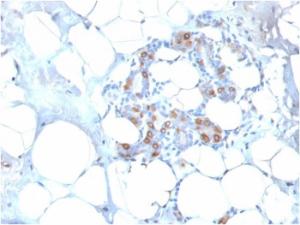 Immunohistochemical analysis of formalin-fixed, paraffin-embedded human breast carcinoma using Anti-HSP27 Antibody [SPM252]