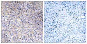 Immunohistochemical analysis of paraffin-embedded human cervix carcinoma tissue using Anti-MRPL11 Antibody. The right hand panel represents a negative control, where the antibody was pre-incubated with the immunising peptide