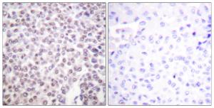 Immunohistochemical analysis of paraffin-embedded human breast carcinoma tissue using Anti-Histone H2B Antibody The right hand panel represents a negative control, where the antibody was pre-incubated with the immunising peptide