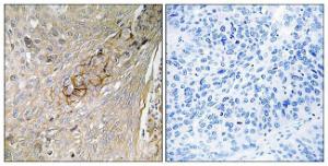 Immunohistochemical analysis of paraffin-embedded human lung carcinoma tissue using Anti-SLC6A6 Antibody. The right hand panel represents a negative control, where the antibody was pre-incubated with the immunising peptide.