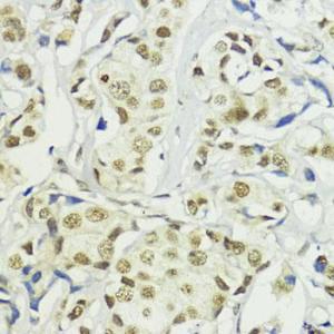 Immunohistochemistry analysis of paraffin-embedded human mammary cancer using Anti-BAZ2A/TIP5 Antibody (A93167) at a dilution of 1:200 (40X lens). Perform microwave antigen retrieval with 10 mM PBS buffer pH 7.2 before commencing with IHC staining protocol