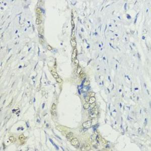 Immunohistochemistry analysis of paraffin-embedded human colon carcinoma tissue using Anti-BAZ2A/TIP5 Antibody (A93167) at a dilution of 1:200 (40X lens). Perform microwave antigen retrieval with 10 mM PBS buffer pH 7.2 before commencing with IHC staining protocol