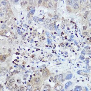 Immunohistochemistry analysis of paraffin-embedded human liver cancer using Anti-FANCC Antibody (A8967) at a dilution of 1:100 (40X lens). Perform high pressure antigen retrieval with 10 mM citrate buffer pH 6.0 before commencing with IHC staining protocol