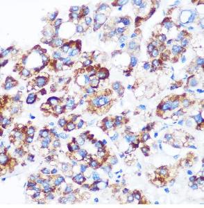 Immunohistochemistry analysis of paraffin-embedded human liver cancer using Anti-SPOUT1 Antibody (A306220) at a dilution of 1:100 (40x lens)