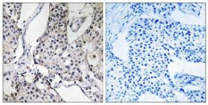 Immunohistochemical analysis of paraffin-embedded human breast carcinoma tissue using Anti-PHLDA3 Antibody. The right hand panel represents a negative control, where the antibody was pre-incubated with the immunising peptide