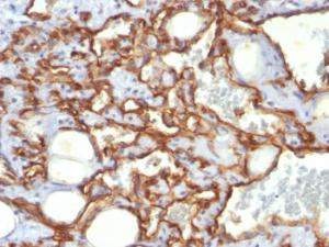 Immunohistochemical analysis of formalin-fixed, paraffin-embedded human angiosarcoma using Anti-CD31 Antibody [SPM532]