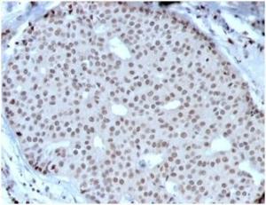 Immunohistochemical analysis of formalin-fixed, paraffin-embedded human breast carcinoma using Anti-HOXB2 Antibody [PCRP-HOXB2-1F2] at 2 µg/ml in PBS for 30  minutes at room temperature