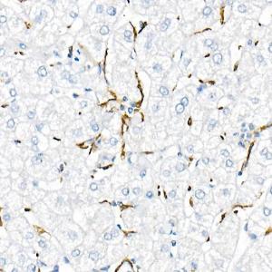 Immunohistochemistry analysis of paraffin-embedded human liver cancer using Anti-TNF alpha Antibody [ARC52538] (A309118) at a dilution of 1:1000(40X lens). Perform high pressure antigen retrieval with 10 mM citrate buffer pH 6.0 before commencing with IHC staining protocol