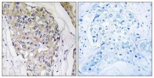 Immunohistochemical analysis of paraffin-embedded human breast carcinoma tissue using Anti-NDUFS6 Antibody. The right hand panel represents a negative control, where the antibody was pre-incubated with the immunising peptide.