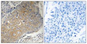 Immunohistochemical analysis of paraffin-embedded human lung carcinoma tissue using Anti-MRPS33 Antibody. The right hand panel represents a negative control, where the Antibody was pre-incubated with the immunising peptide