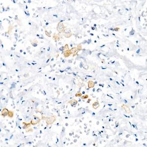 Immunohistochemistry analysis of paraffin-embedded human lung using Anti-TNF alpha Antibody [ARC52538] (A309118) at a dilution of 1:1000(40X lens). Perform high pressure antigen retrieval with 10 mM citrate buffer pH 6.0 before commencing with IHC staining protocol