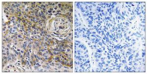 Immunohistochemical analysis of paraffin-embedded human breast carcinoma tissue using Anti-CD147 Antibody. The right hand panel represents a negative control, where the Antibody was pre-incubated with the immunising peptide