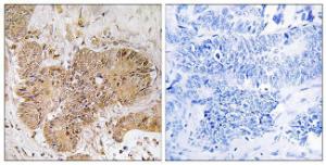 Immunohistochemical analysis of paraffin-embedded human colon carcinoma tissue using Anti-LUC7L2 Antibody. The right hand panel represents a negative control, where the antibody was pre-incubated with the immunising peptide