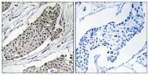 Immunohistochemical analysis of paraffin-embedded human breast carcinoma tissue using Anti-KCNAB3 Antibody. The right hand panel represents a negative control, where the antibody was pre-incubated with the immunising peptide.