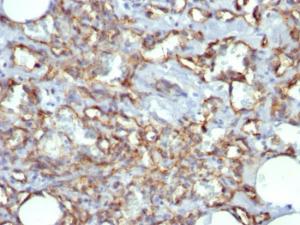 Immunohistochemical analysis of formalin-fixed, paraffin-embedded human angiosarcoma using Anti-CD31 Antibody [JC/70A]