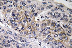 Immunohistochemical analysis of paraffin-embedded human lung carcinoma tissue using Anti-GCS-beta-2 Antibody