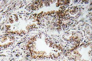 Immunohistochemical analysis of paraffin-embedded human prostate carcinoma tissue using Anti-AChRalpha1 Antibody