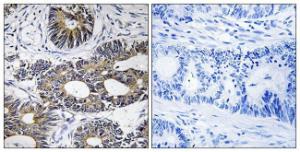 Immunohistochemical analysis of paraffin-embedded human colon carcinoma tissue using Anti-EIF1AY Antibody. The right hand panel represents a negative control, where the antibody was pre-incubated with the immunising peptide.