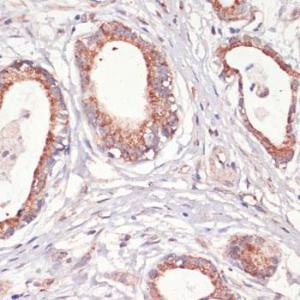 Immunohistochemistry analysis of paraffin-embedded human gastric cancer using Anti-Caspase-3 Antibody (A93186) at a dilution of 1:200 (40X lens). Perform microwave antigen retrieval with 10 mM PBS buffer pH 7.2 before commencing with IHC staining protocol