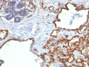 Immunohistochemical analysis of formalin-fixed, paraffin-embedded human angiosarcoma using Anti-CD31 Antibody [SPM122]