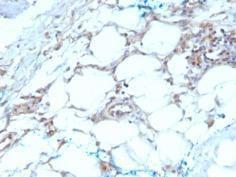 Immunohistochemical analysis of formalin-fixed, paraffin-embedded human mesothelioma using Anti-Calretinin Antibody [CALB2/2603]