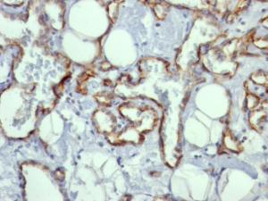 Immunohistochemical analysis of formalin-fixed, paraffin-embedded human angiosarcoma using Anti-CD31 Antibody [C31.10]