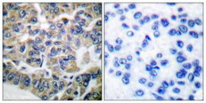 Immunohistochemical analysis of paraffin-embedded human breast carcinoma tissue using Anti-eEF2K Antibody. The right hand panel represents a negative control, where the antibody was pre-incubated with the immunising peptide