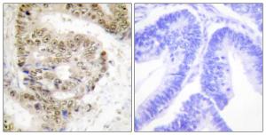 Immunohistochemical analysis of paraffin-embedded human colon carcinoma tissue using Anti-hnRNP L Antibody The right hand panel represents a negative control, where the antibody was pre-incubated with the immunising peptide