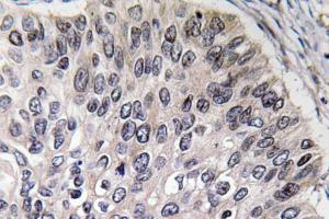 Immunohistochemical analysis of paraffin-embedded human lung carcinoma tissue using Anti-CA II Antibody