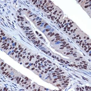 Immunohistochemistry analysis of paraffin-embedded human colon carcinoma tissue using Anti-WDR4 Antibody [ARC2292] (A305320) at a dilution of 1:100 (40x lens). Perform microwave antigen retrieval with 10 mM Tris/EDTA buffer pH 9.0 before commencing with IHC staining protocol.